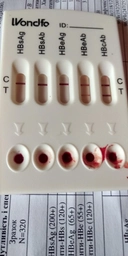 Тест на 5 маркеров гепатита В Wondfo HBsAg, HBsAb, HBeAg, HBeAb, HBcAb - HBV W040-P фото от покупателей 2