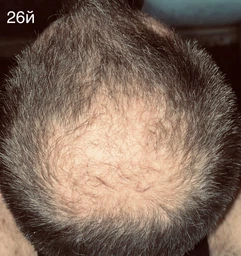 5% Minoxidil Kirkland для росту волосся та бороди (3 флакона + дозатор) фото від покупців 17