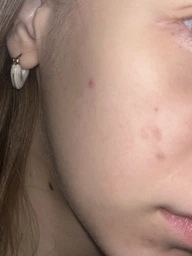 Гель-крем тройного действия La Roche-Posay Effaclar Duo+M для Коррекции недостатков проблемной кожи и Предотвращения их повторного появления 40 мл (3337875863377) фото от покупателей 1
