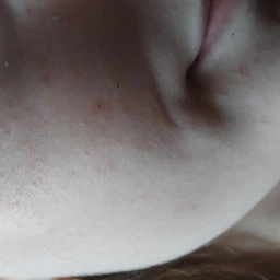 Точечный крем-гель RE.CARE SOS Spot Targeted Care Против высыпаний быстрого действия 15 мл (4823109410060) фото от покупателей 3