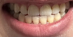 Корректор цвета зубов SmileKit V34 30 мл (405541) фото от покупателей 2