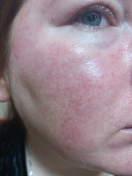 Сыворотка SKIN1004 Madagascar Centella Ampoule успокаивающая с центеллой 30 мл фото от покупателей 2