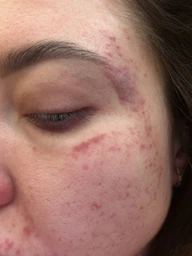 Пигментный Отбеливающий Крем с Гидрохиноном 4% 30 грамм | Abbott Hydroquinone Cream USP Melalite Forte | Expigment | Мелалит фото от покупателей 3