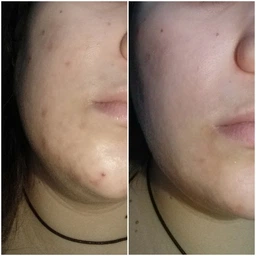 Третиноин гель 0,025% (Tretinoin Gel USP 0.025% Menarini) 20г. От прыщей,морщин.