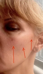 Пигментный отбеливающий крем с гидрохиноном 4% Abbott (Hydroquinone Cream USP Melalite Forte) для лица 30 г