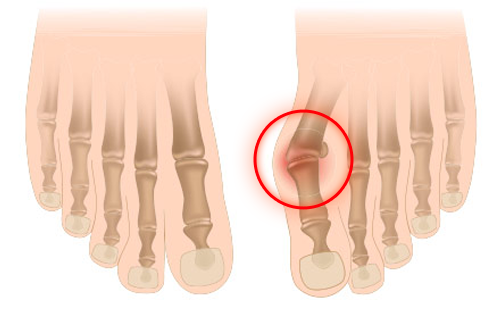 Ортопедический протектор на косточку пальцев ноги с перегородкой Foot Care GB-02 (Valgus Pro) - изображение 2