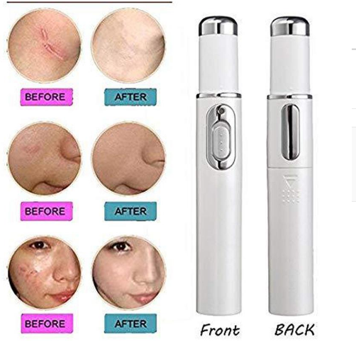 Лазерная ручка для удаления акне и уменьшения морщин на коже KD-7910 Blue Light Acne Treatment Белая (KG-104) - изображение 4