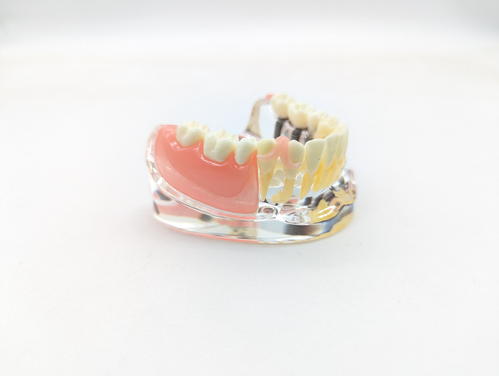 Модель стоматологічна імплантація та знімне протезування фантом - зображення 1