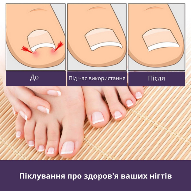 Набор пластырей Elastic Toenail Correction Sticker для безболезненной коррекции вросших ногтей (50 шт.) - изображение 2