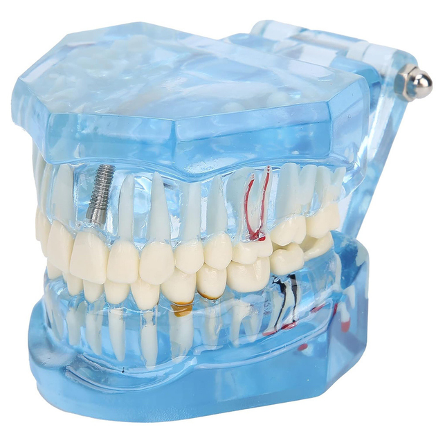 Стоматологічна модель із зубами, карієсом, імплантом, періодонтитом, каменем. - зображення 1