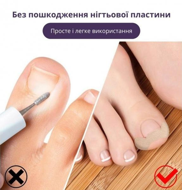 Набір еластичних пластирів Elastic Toenail Correction Sticker для безболісного виправлення врослих нігтів (50 шт.) - изображение 2