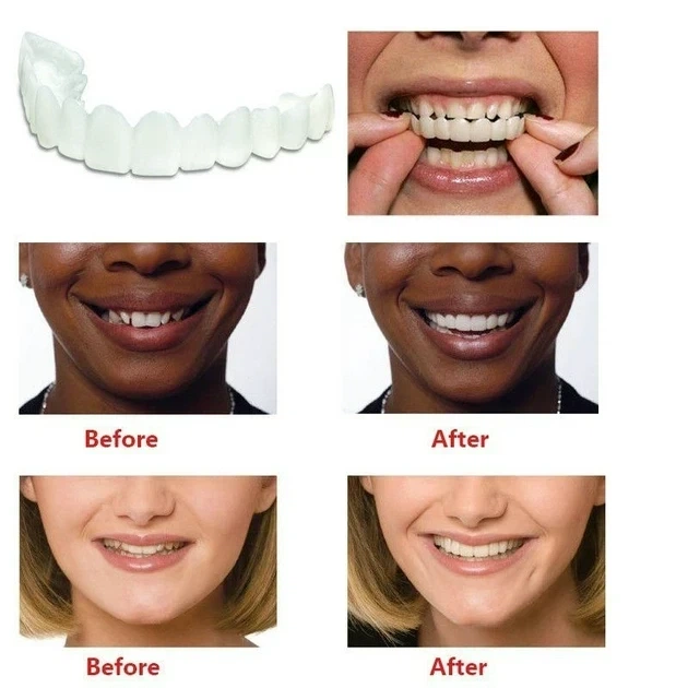 Знімні вініри для зубів Veneers smile, накладні зуби верх і низ у кейсі - зображення 6