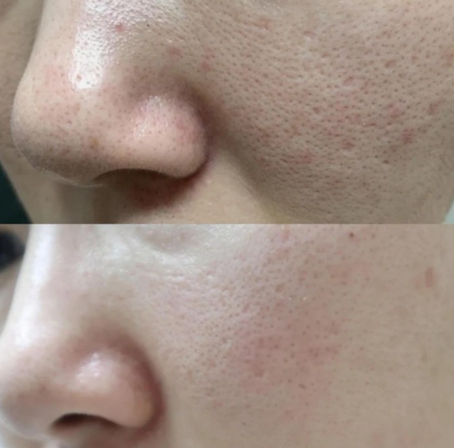 Сыворотка с экзосомами и спикулами для сужения пор Medicube One Day Exosome Shot Pore Ampoule 7500 30ml - изображение 8