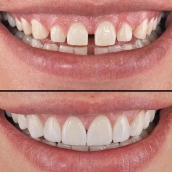 Накладка на зуби Tooth Cover вініри Perfect Smile - зображення 4