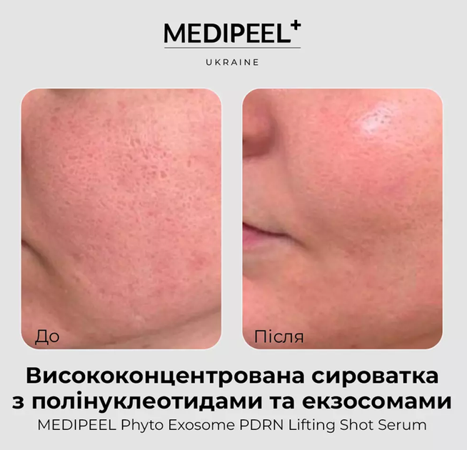Антивозрастная лифтинг-сыворотка с PDRN и экзосомами Medi-Peel Phyto Exosome PDRN Lifting Shot Serum, 50 мл - Фото 4 Антивозрастная лифтинг-сыворотка с PDRN и экзосомами Medi-Peel Phyto Exosome PDRN Lifting Shot Serum, 50 мл - изображение 4
