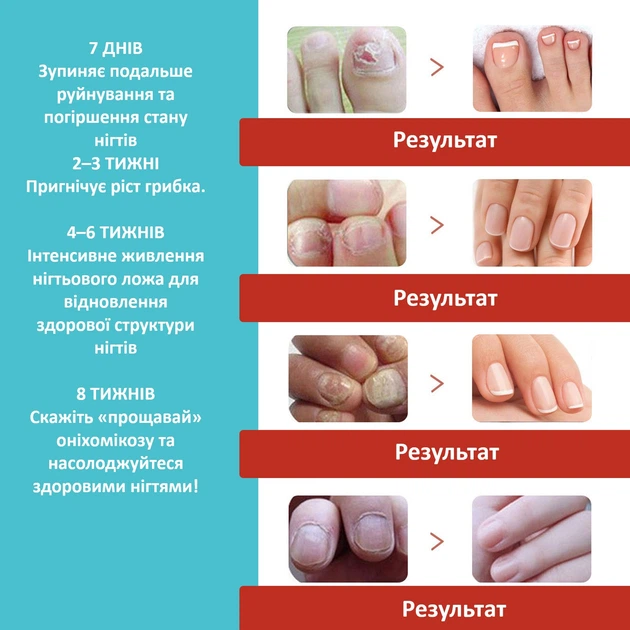 Наклейки-пластыри для ухода за вросшими ногтями Nail Patches, 16 шт в упаковке U9360 - Фото 3 Наклейки-пластыри для ухода за вросшими ногтями Nail Patches, 16 шт в упаковке U9360 - изображение 3