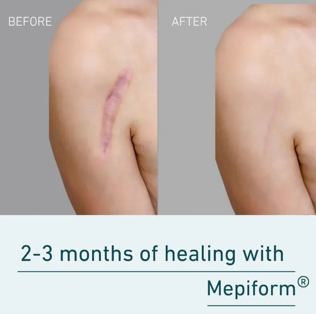 Силиконовый пластырь Мепиформ Mepiform 10x18 см 5 шт для лечения гипертрофических и келоидных рубцов - Фото 6 Силиконовый пластырь Мепиформ Mepiform 10x18 см 5 шт для лечения гипертрофических и келоидных рубцов - изображение 6