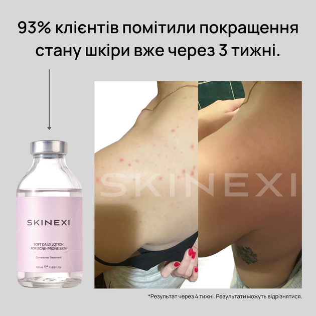 Лосьйон для проблемної шкіри від комедонів та чорних цяток Skinexi Soft Daily Lotion 100 мл - Фото 3 Лосьйон для проблемної шкіри від комедонів та чорних цяток Skinexi Soft Daily Lotion 100 мл - зображення 3