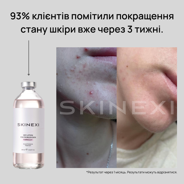 Лосьон для проблемной кожи от прыщей и акне Skinexi Dry Lotion Formula+ 250 мл - Фото 4 Лосьон для проблемной кожи от прыщей и акне Skinexi Dry Lotion Formula+ 250 мл - изображение 4