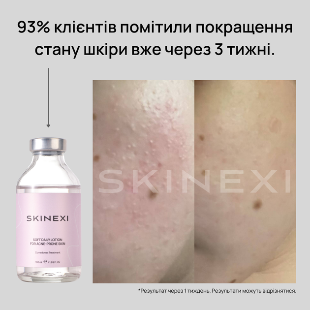 Лосьйон для проблемної шкіри від комедонів та чорних цяток Skinexi Soft Daily Lotion 100 мл - Фото 4 Лосьйон для проблемної шкіри від комедонів та чорних цяток Skinexi Soft Daily Lotion 100 мл - зображення 4