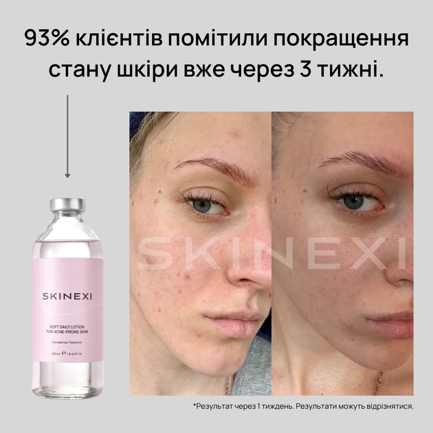 Лосьйон для проблемної шкіри від комедонів та чорних цяток Skinexi Soft Daily Lotion 250 мл - Фото 5 Лосьйон для проблемної шкіри від комедонів та чорних цяток Skinexi Soft Daily Lotion 250 мл - зображення 5