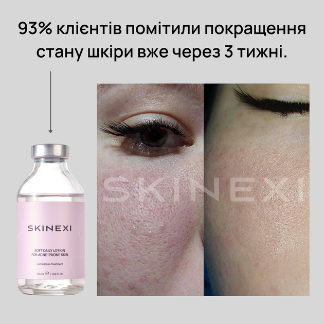 Лосьйон для проблемної шкіри від комедонів та чорних цяток Skinexi Soft Daily Lotion 100 мл - Фото 6 Лосьйон для проблемної шкіри від комедонів та чорних цяток Skinexi Soft Daily Lotion 100 мл - зображення 6