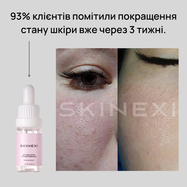 Лосьйон для проблемної шкіри від комедонів та чорних цяток Skinexi Soft Daily Lotion 15 мл - Фото 6 Лосьйон для проблемної шкіри від комедонів та чорних цяток Skinexi Soft Daily Lotion 15 мл - зображення 6