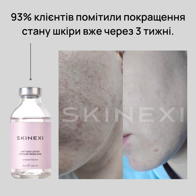 Лосьйон для проблемної шкіри від комедонів та чорних цяток Skinexi Soft Daily Lotion 100 мл - Фото 7 Лосьйон для проблемної шкіри від комедонів та чорних цяток Skinexi Soft Daily Lotion 100 мл - зображення 7