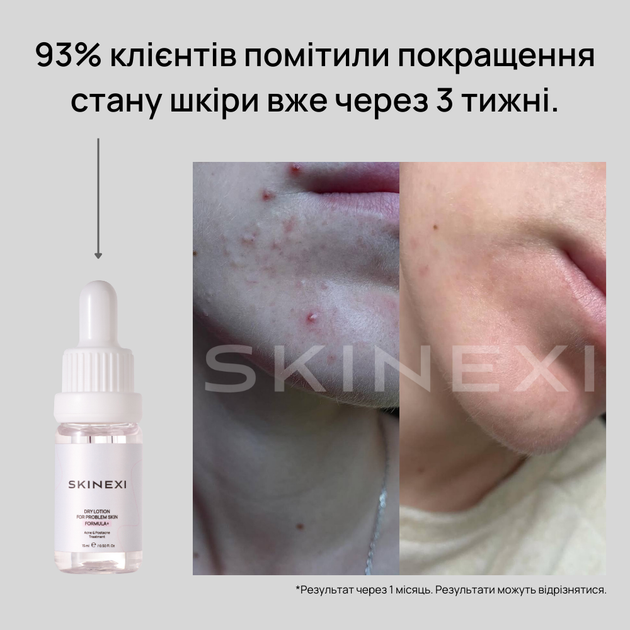 Лосьон для проблемной кожи от прыщей и акне Skinexi Dry Lotion Formula+ 15 мл - Фото 4 Лосьон для проблемной кожи от прыщей и акне Skinexi Dry Lotion Formula+ 15 мл - изображение 4