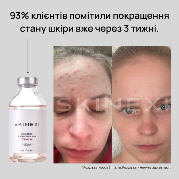 Лосьйон для проблемної шкіри від прищів та акне Skinexi Dry Lotion Formula+ 100 мл - Фото 6 Лосьйон для проблемної шкіри від прищів та акне Skinexi Dry Lotion Formula+ 100 мл - зображення 6