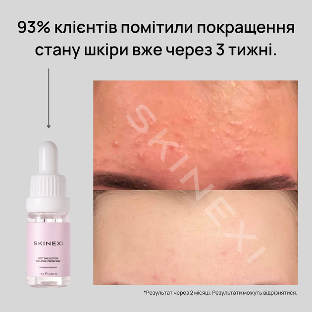 Лосьйон для проблемної шкіри від комедонів та чорних цяток Skinexi Soft Daily Lotion 15 мл - Фото 8 Лосьйон для проблемної шкіри від комедонів та чорних цяток Skinexi Soft Daily Lotion 15 мл - зображення 8