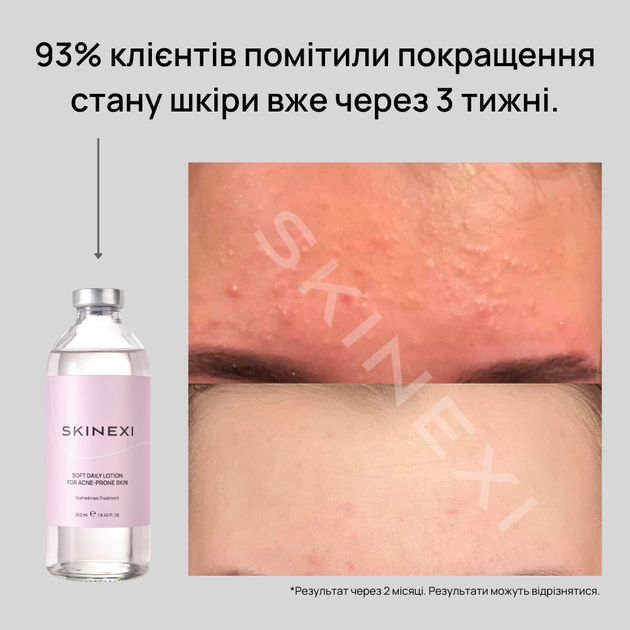 Лосьйон для проблемної шкіри від комедонів та чорних цяток Skinexi Soft Daily Lotion 250 мл - Фото 8 Лосьйон для проблемної шкіри від комедонів та чорних цяток Skinexi Soft Daily Lotion 250 мл - зображення 8