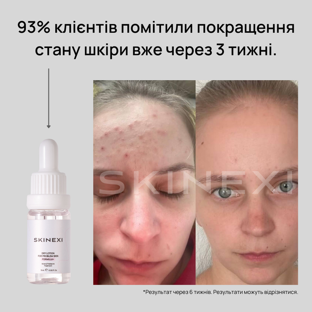 Лосьон для проблемной кожи от прыщей и акне Skinexi Dry Lotion Formula+ 15 мл - Фото 6 Лосьон для проблемной кожи от прыщей и акне Skinexi Dry Lotion Formula+ 15 мл - изображение 6