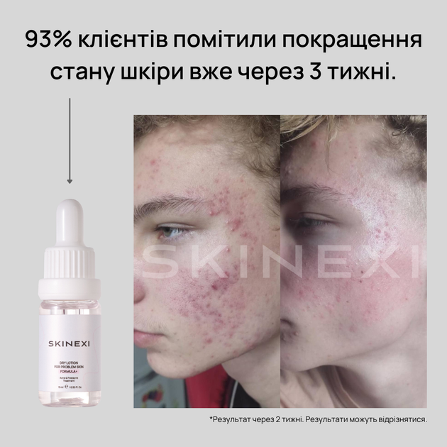Лосьон для проблемной кожи от прыщей и акне Skinexi Dry Lotion Formula+ 15 мл - Фото 7 Лосьон для проблемной кожи от прыщей и акне Skinexi Dry Lotion Formula+ 15 мл - изображение 7