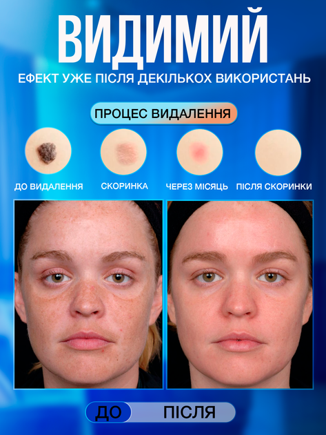 Электрокоагулятор плазменный косметологический прибор профессиональный для удаления родинок папиллом бородавок тату веснушек пигментных пятен VLVEE аппарат электро коагулятор для салона и дома - изображение 4