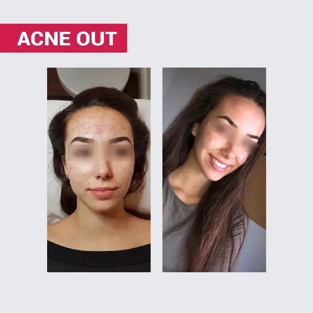 Biotrade (Біотрейд) Acne Out Oxy Wash Cleansing Gel – ніжний гель для вмивання з киснем та молочною кислотою, для жирної та проблемної шкіри обличчя, 200 мл - изображение 2