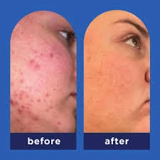 Очищающий эксфолиант с салициловой кислотой Panoxyl Clarifying exfoliant - изображение 4