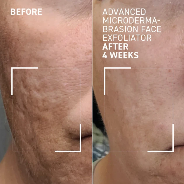 Пілінг-мікродермабразія для вирівнювання текстури Dr. Brandt MicroDermabrasion Advanced Face Exfoliator 60 мл - зображення 8