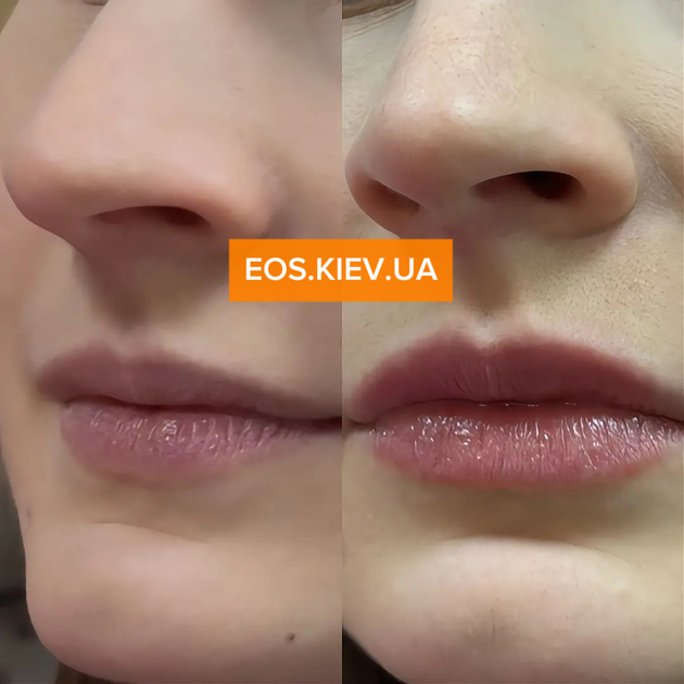 Плампер для губ з мікроголками VT COSMETICS Reedle Shot Lip Plumper Beginner 4.3 г - зображення 3