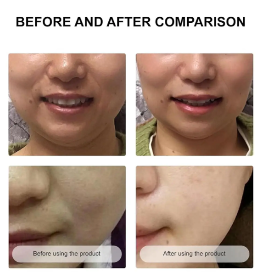 Secret Strips Anti-Wrinkle Smile Line Patches — пластыри для лица с сывороткой для лифтинга и обновления кожи, 10 шт. + 8 мл - Фото 4 Secret Strips Anti-Wrinkle Smile Line Patches — пластыри для лица с сывороткой для лифтинга и обновления кожи, 10 шт. + 8 мл - изображение 4