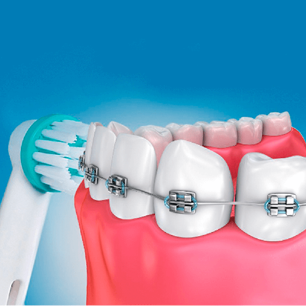 Насадки змінні Ortho Care (OD17-2) для зубної щітки Oral-B для брекет-систем для брекетів - зображення 7