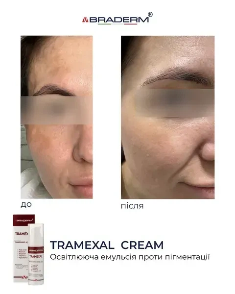 Осветляющий крем BRADERM Tramexal Cream, 30 мл 00-00000388 - изображение 5