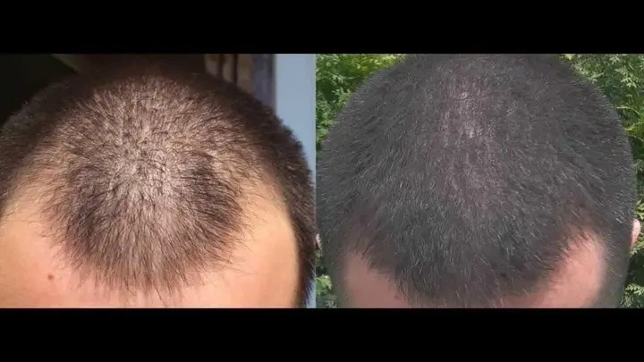 Лосьйон Kirkland для росту волосся Minoxidil 5% (6 шт. по 60 мл) - зображення 4