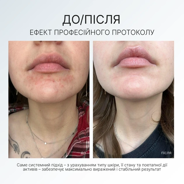 Балансирующий крем-гель при розацеа REDNESS BALANCE CREAM GEL AG Skin 50 мл - Фото 4 Балансирующий крем-гель при розацеа REDNESS BALANCE CREAM GEL AG Skin 50 мл - изображение 4