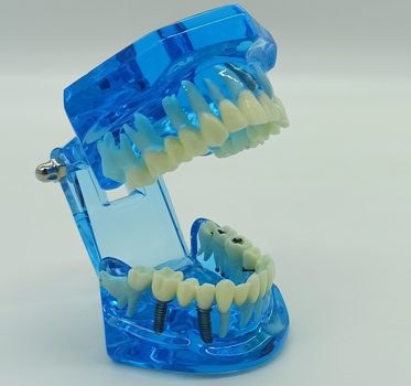 Стоматологічна модель із зубами карієсом імплантом періодонтитом каменем колір синій