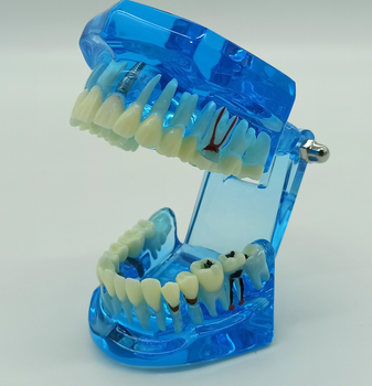 Стоматологічна модель із зубами карієсом імплантом періодонтитом каменем колір синій