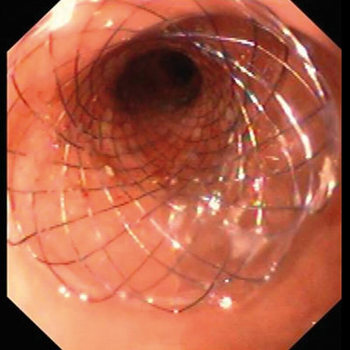 Дуоденальний стент MICRO-TECH Double Spherical частково з покриттям