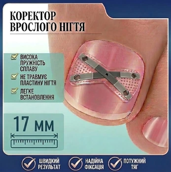 Коректор врослого нігтя X-подібний, нікелевий сплав Ingrown Toenail Correction Kit, Розмір 17 мм
