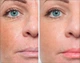 Мезороллер профессиональный Derma Roller на 2 мм, 540 игл - изображение 5
