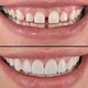 Вініри зубні Perfect Smile Veneers змінні білі - зображення 2